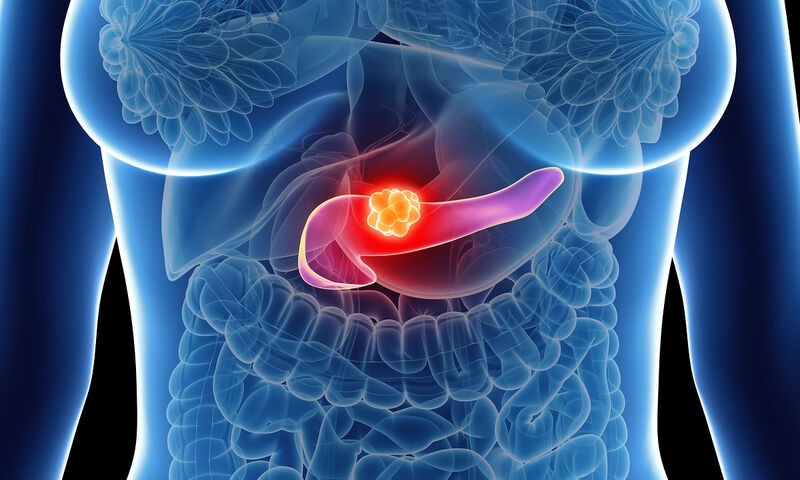 Έβδομος συχνότερος σε άνδρες και 8ος σε γυναίκες στην Κύπρο ο καρκίνος παγκρέατος